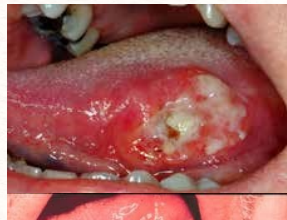 <p>90% of oral cancers that causes red (erythroplakia), white (leukoplakia), or a mix of both (erythroleukoplakia) sometimes with an ulcer</p>