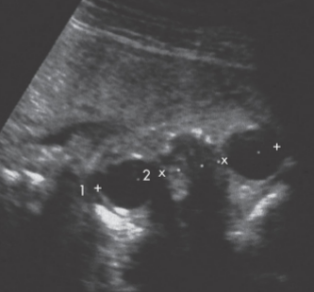 <p>what are the x shaped calipers measuring?</p>