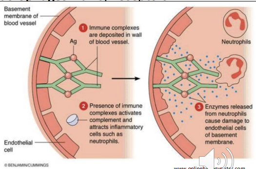 <ul><li><p>immune complex </p></li><li><p>Mediated by IgG binding to <strong>soluble antigens</strong> → <u>immune complex formation</u> - </p></li><li><p>normally cleared but can acculate - <em>Deposition </em>of complexes in <strong>blood vessels,</strong> joints (synovial fluid), and other tissues -</p></li><li><p><strong>Complement activation </strong>→ release of C3a, C5a (inflammation, chemotaxis) -</p></li><li><p><strong>Recruitment of neutrophils &amp; macrophages</strong> via Fc<sup>γ</sup> receptors -<em> Mast cell activation and vascular perimability - more leukocytes to area&nbsp;</em></p></li><li><p><strong>Tissue damage</strong></p></li><li><p><strong><mark data-color="#ffadad" style="background-color: rgb(255, 173, 173); color: inherit;">Non–organ-specific </mark></strong><mark data-color="#ffadad" style="background-color: rgb(255, 173, 173); color: inherit;">autoimmune diseases</mark></p></li><li><p>Examples: SLE, RA, post-streptococcal glomerulonephritis)</p></li></ul><p></p>