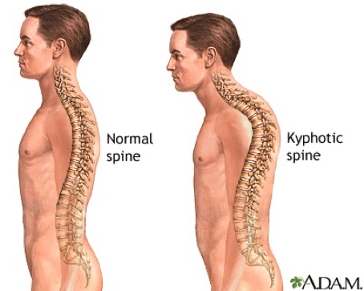 <p>•Anterior wedging of >5 degrees in at least 3 vertebrae</p><p>•Thoracic spine commonly effected</p>