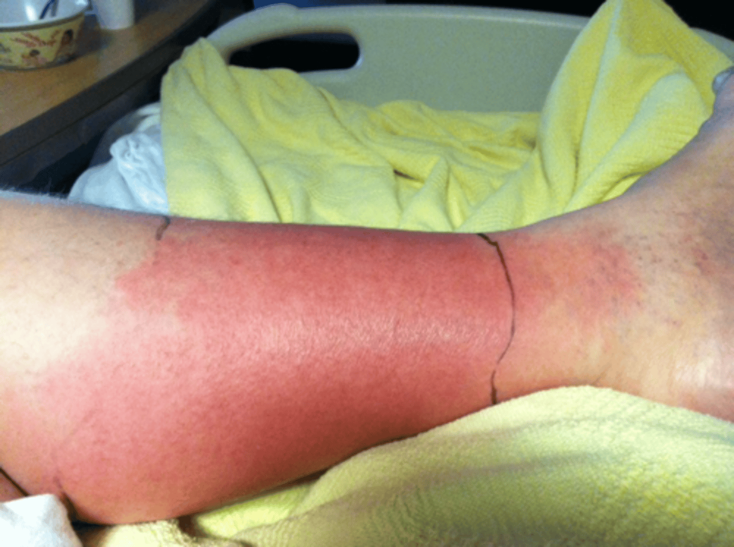 <p>Cellulitis</p>