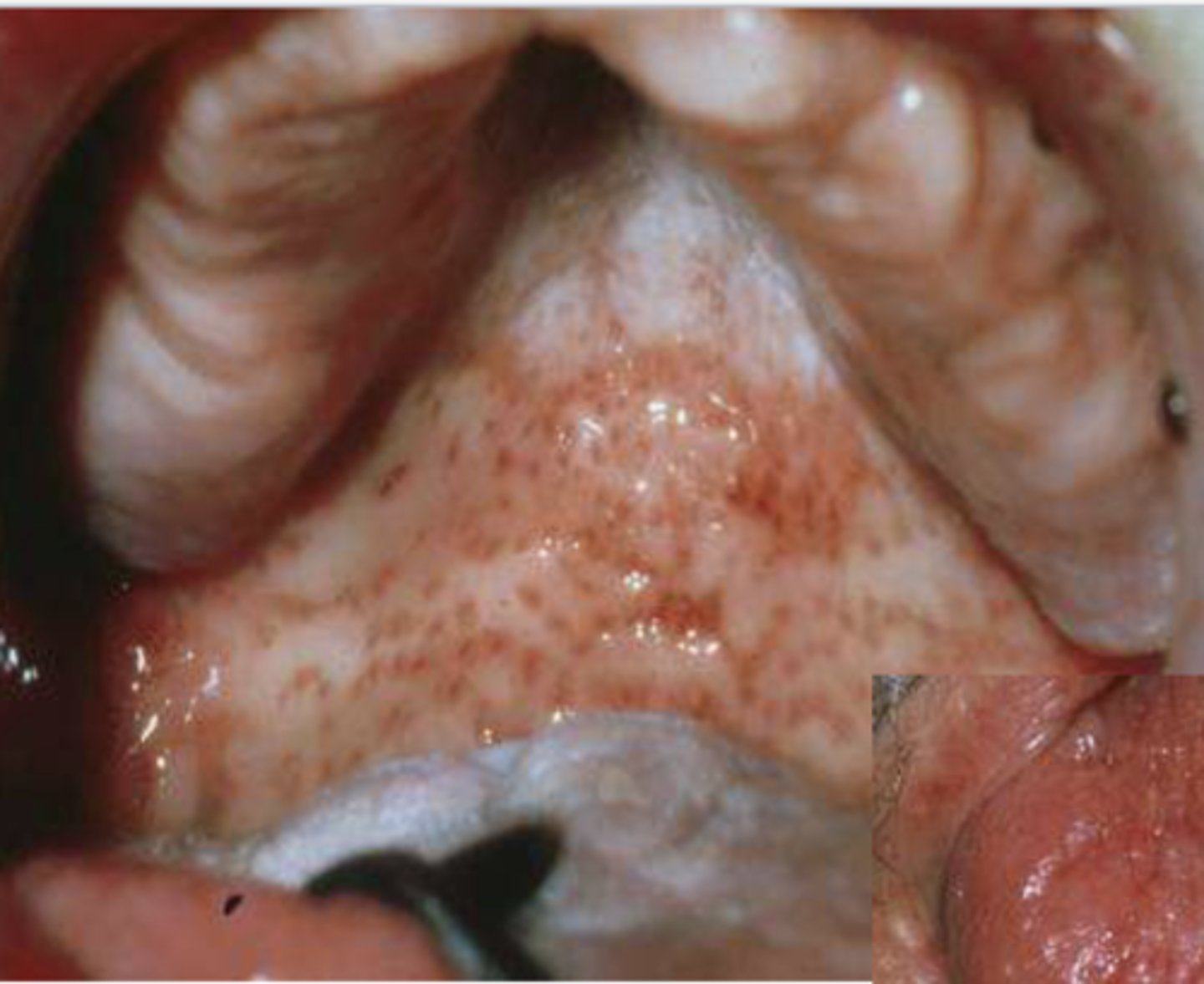 <p>Patient reported undergoing radiotherapy 2 weeks ago. What do you suspect?</p>