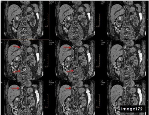 <p><span><strong>The red arrows in Image 172 are indicative of which type of MRI artifact?</strong></span></p>