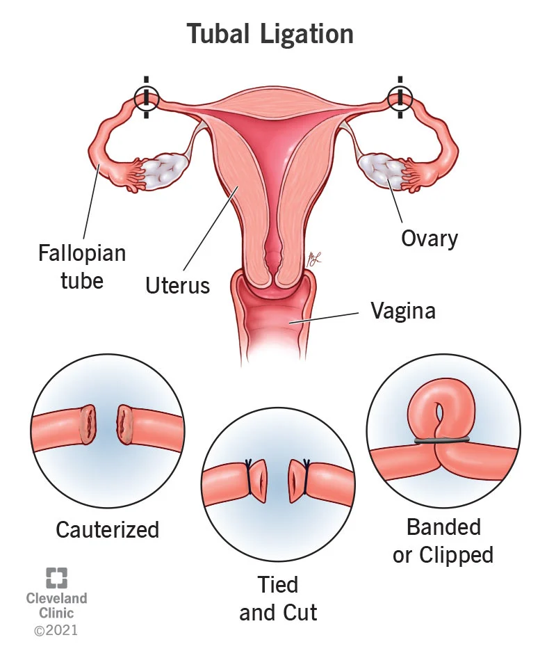 <p><strong>Introduction to ACC</strong></p><p><u>Facts</u>: A woman who became pregnant following a failed sterilisation brought proceedings against the medical practitioner in tort. The medical practitioner sought to strike out the proceedings on the basis that the pregnancy was covered (under s 317(1)). There had been a CA decision holding that pregnancy was not personal injury (<em>ACC v D</em>). <em>Allenby</em> appeal considered whether D was correct.</p><p><u>Issue</u>: Whether pregnancy is covered under s 317(1) of the Act?</p><p><u>Law</u>:</p><ul><li><p>Physical injury (s 26(1)(b)) included pregnancy following a failed sterilisation</p><ul><li><p>Blanchard J:</p><ul><li><p>“Cover under s 20 is… available only if, first, the claimant has suffered a person injury and, second, that injury was caused in one of the specified ways.”</p></li><li><p>“Pregnancy as a result of sexual violation clearly covered: s 20(2)(a): which reflects the legislative history”</p></li><li><p>“Since… an impregnantion resulting from rape is… personal injury, it must follow that an impregnation resulting from [treatment injury] in the form of a failed sterilisation is also a personal injury.”</p></li></ul></li><li><p>Mallon J: (from a different case)</p><ul><li><p>“[Pregnancy] qualifies as a personal injury because it has physical impacts. Just as a strain qualifies as a personal injury because it has physical impacts that cause pain and suffering, so too does pregnancy and mesothelioma, because of their physical impacts on the body.”</p></li></ul></li></ul></li><li><p>Tipping J:</p><ul><li><p>“This reasoning does not lead to all unwanted pregnancies being covered by the Act. In order to attract cover the pregnancy must be caused either, as here, by [treatment injury] or by rape.”</p></li><li><p>“I am not suggesting that in other contexts, such as sports injuries, the presence or absence of consent should dictate whether an accident had occurred.”</p><ul><li><p>Consent to sex is relevant to whether there is an accident</p></li></ul></li></ul></li></ul>