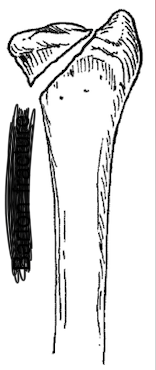 <p>What type of fracture is this?</p>