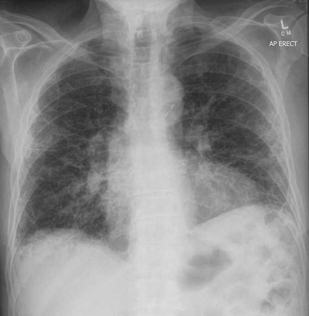 <p>Identify this pathology</p>