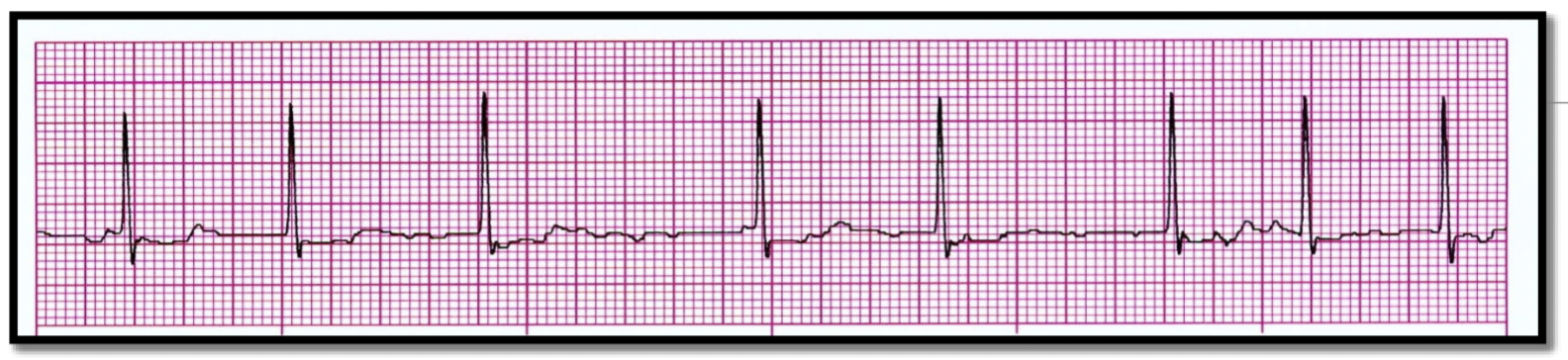 <p>What is the rhythm?</p>