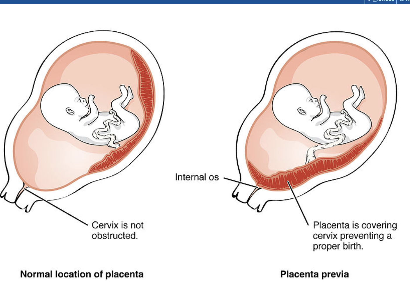 <ul><li><p>placenta is either partially or completely over the cervix</p></li><li><p><strong>painless bright red </strong>vaginal bleeding </p></li></ul><p></p>