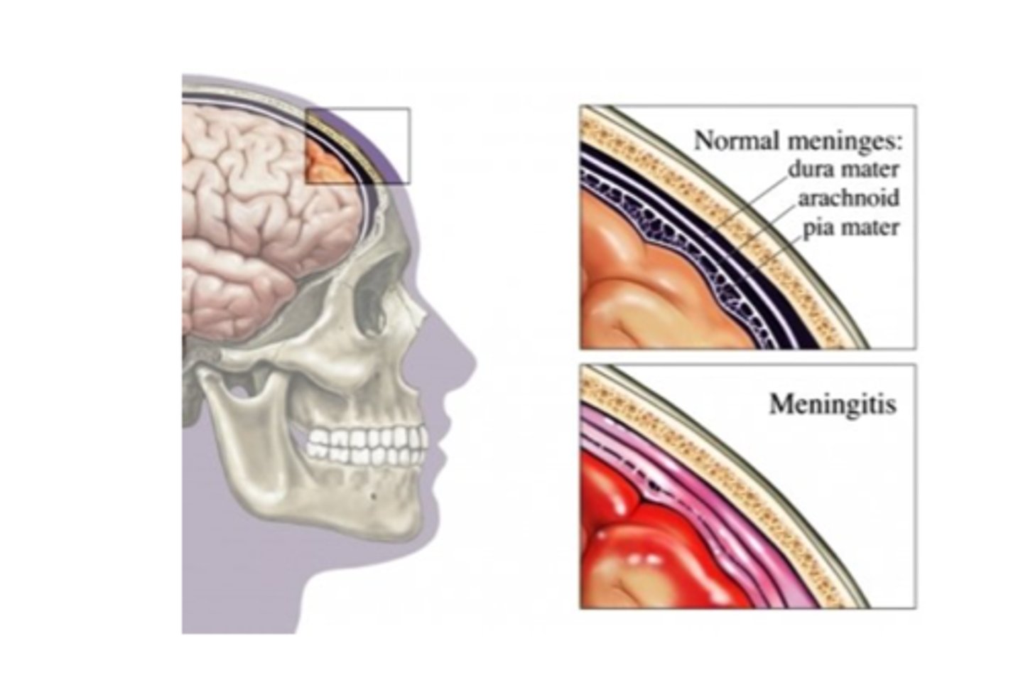 <p>Bacterial meningitis (medical emergency) and viral meningitis,</p><p>inflamed meninges</p>