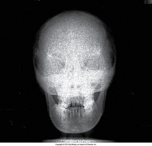 Why is this image grainy?