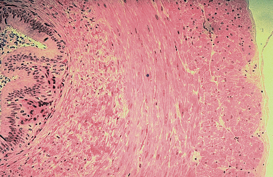 <p><strong>Vas deferens</strong></p><ul><li><p class=""><strong>Pseudostratified columnar epithelium</strong> with <strong>stereocilia</strong></p></li><li><p class=""><strong>Small, irregular star-shaped lumen</strong> compared to thick wall</p></li><li><p class="">Surrounded by a <strong>very thick muscularis</strong> with <strong>three layers</strong>: inner longitudinal, middle circular, outer longitudinal</p></li><li><p class="">Often has a <strong>folded mucosa</strong></p></li></ul><p></p><p><em>Vas deferens stores sperm</em></p>