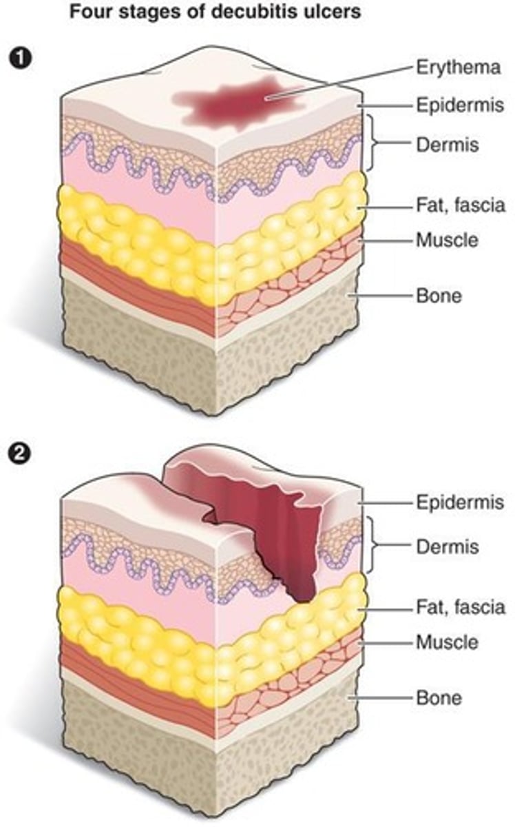 <p>Full thickness loss down to muscle and bone.</p>