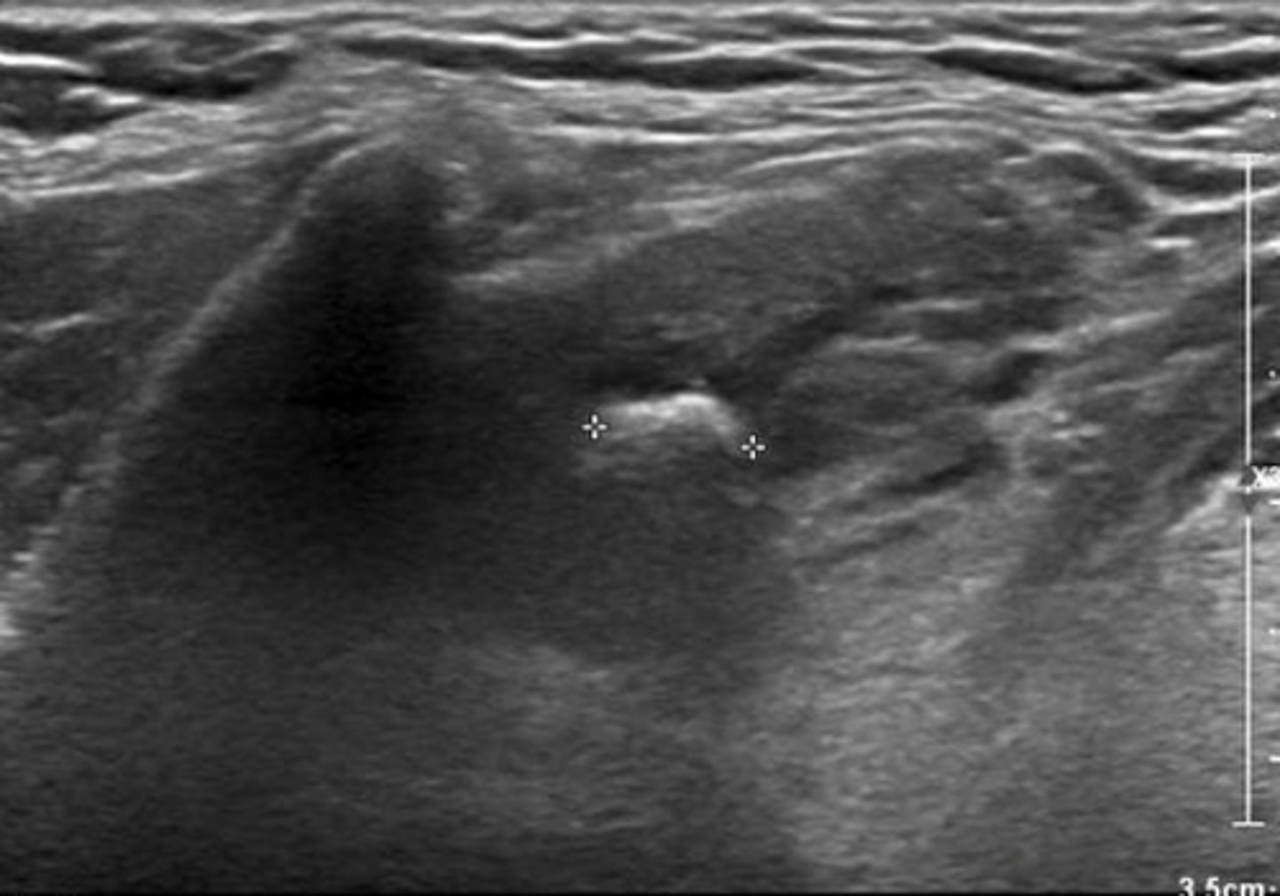 <p>-Submandibular in 60-90% of cases</p><p>-Parotid in 10-20% of cases</p><p>Etiology</p><p>-Infection in 50% of cases</p><p>Clinical findings</p><p>-Pain and swelling during eating </p><p>-Palpable mass</p><p>Sonographic findings</p><p>-Intraductal or intraglandular echogenic focus(i)</p><p>-Posterior acoustic shadowing </p>
