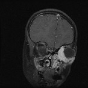<p>What does this refer to</p><ul><li><p> Cranial Nerve Palsies</p></li><li><p> Hearing Loss</p></li><li><p> Chronic aural or sinus drainage </p></li><li><p>Image shows PARAMENINGEAL</p><p></p></li></ul><p></p>