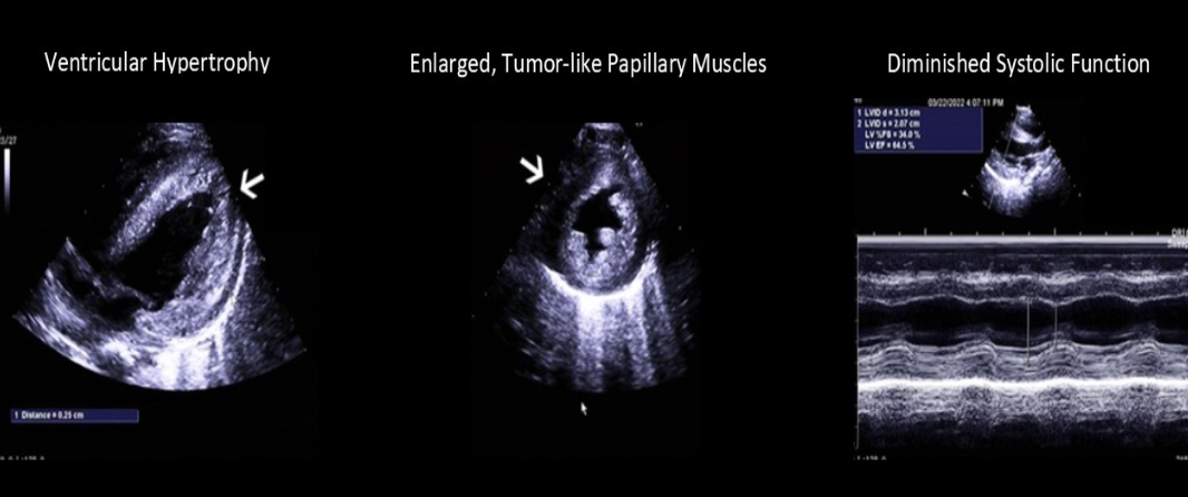 <ol><li><p>Autosomal recessive disease </p></li><li><p>Abnormal storage of glycogen </p></li><li><p>Increased ventricular thickening </p></li></ol><p></p>