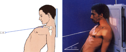 <p>AP axial (clavicle)</p><ul><li><p><span>CR directed 25</span><strong><em><span>°</span></em></strong><span> – 30</span><strong><em><span>°&nbsp;</span></em></strong><span>cephalic (towards head)</span></p></li><li><p><span>&nbsp;AP erect with only shoulders against IR, leaning awkwardly against it&nbsp;</span></p></li></ul><p></p>