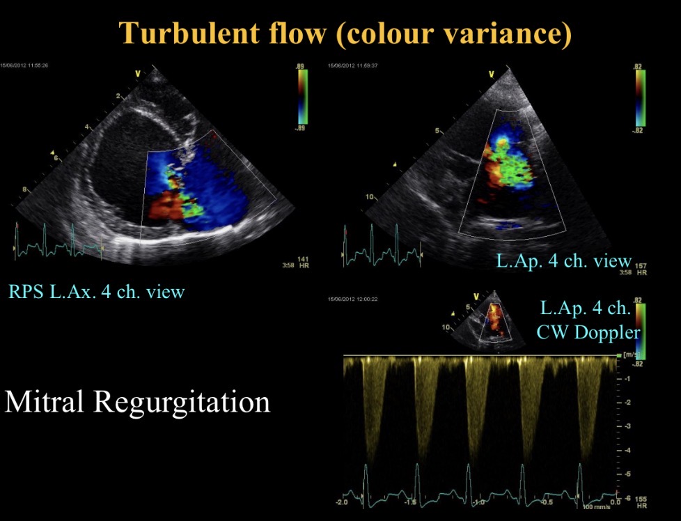 <p>Turbulent flow (M regurgitation)</p>