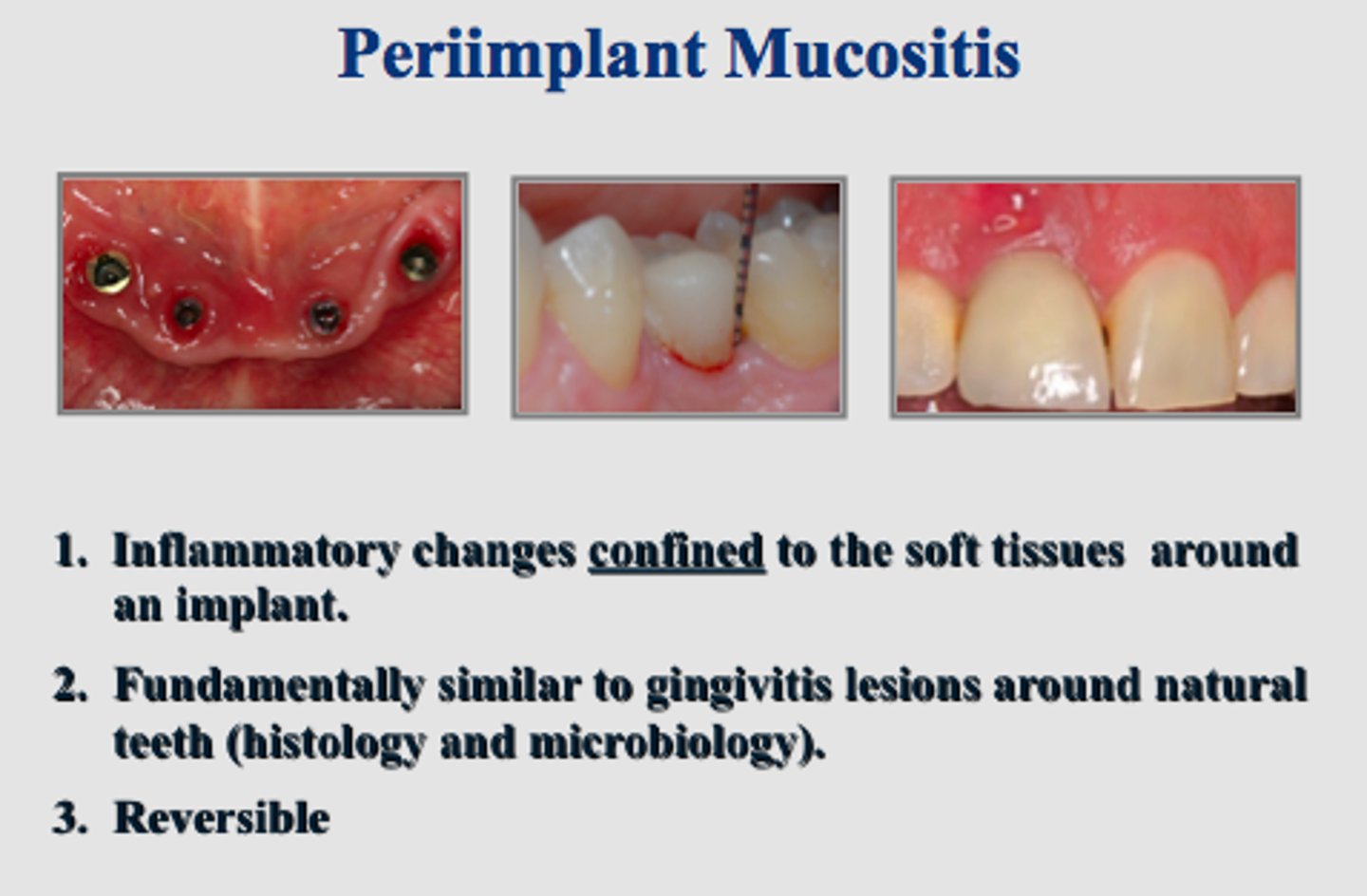 <p>- Inflammation in the peri-implant soft tissues</p><p>- Plaque-induced gingivitis w/ oedema</p><p>- No BL</p>