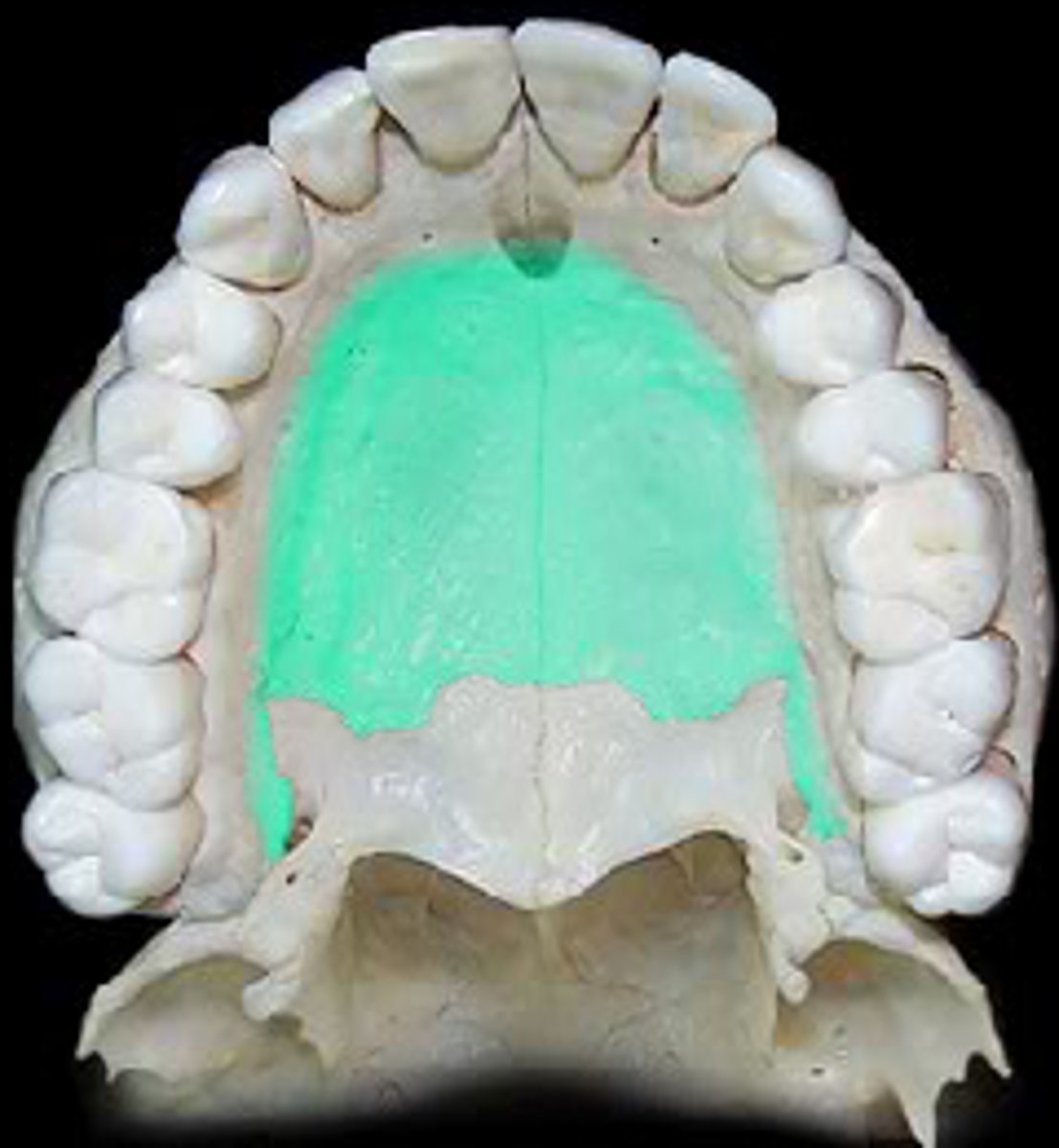 <p>of the Maxilla</p>