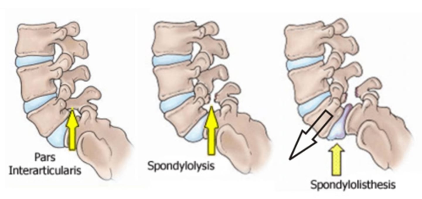 <p>Slippage of L5 on S1 </p><p>- damage spinal nerves / cauda equina</p><p>limited by </p><p>facet orientation (frontal plane) </p><p>- L5 = anterior </p><p>vs.</p><p>- S1 = posterior</p><p>= BLOCKS L5 from slipping anteriorly</p>
