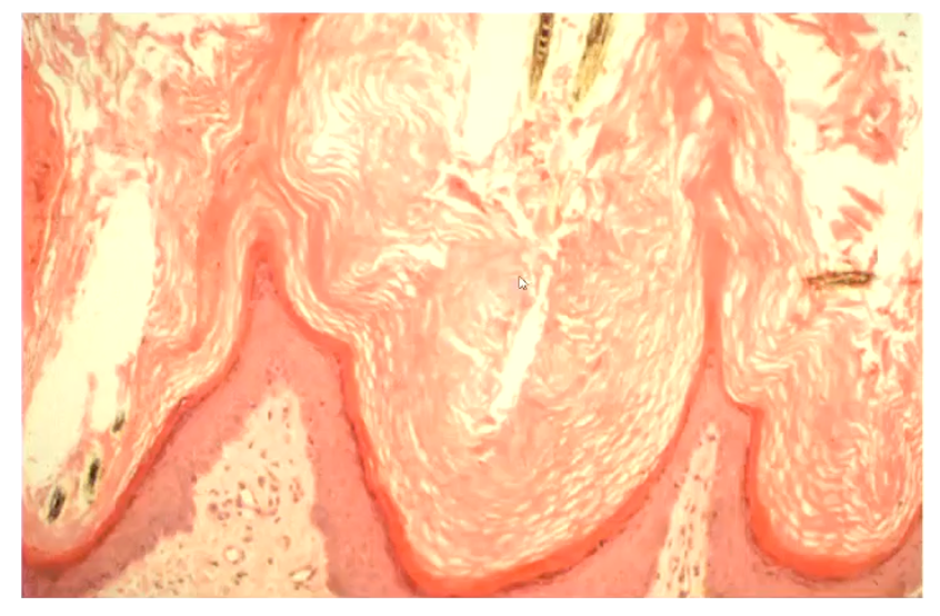 <p>Increase in thickness of anuclear stratum corneum</p><ul><li><p>Grossly, animal would look flaky</p></li></ul><p></p>