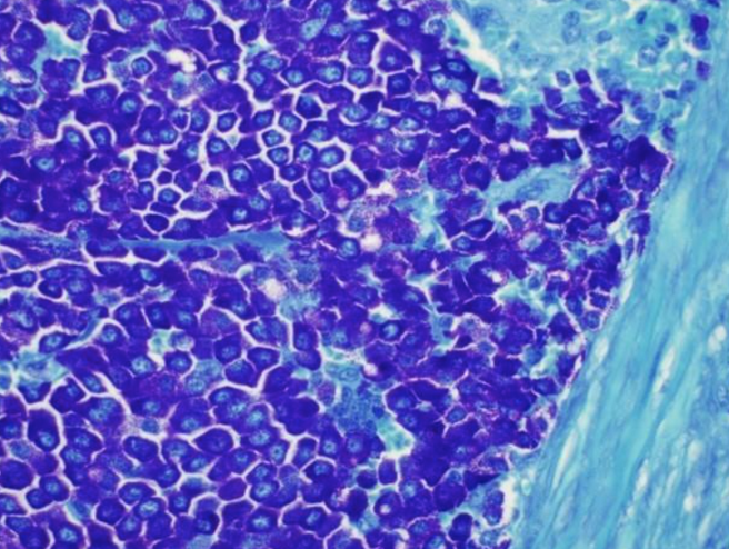 <p>What is the predominant cell type seen on this slide?&nbsp; +&nbsp; What stain was used to visualize them?</p>