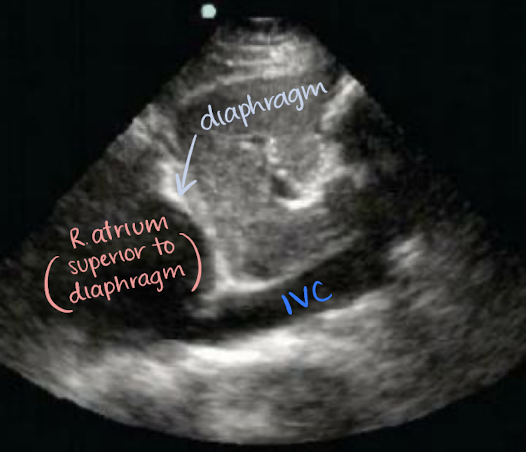 <p>right atrium</p>
