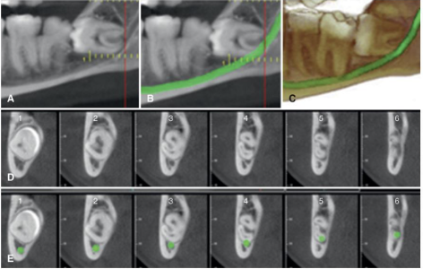 <p>CBCT is better than panoramic because you can see the number of roots, apical divergence, direct contact with IAC and predicting IAN exposure during surgery but was NOT better at predicting postoperative complications</p>