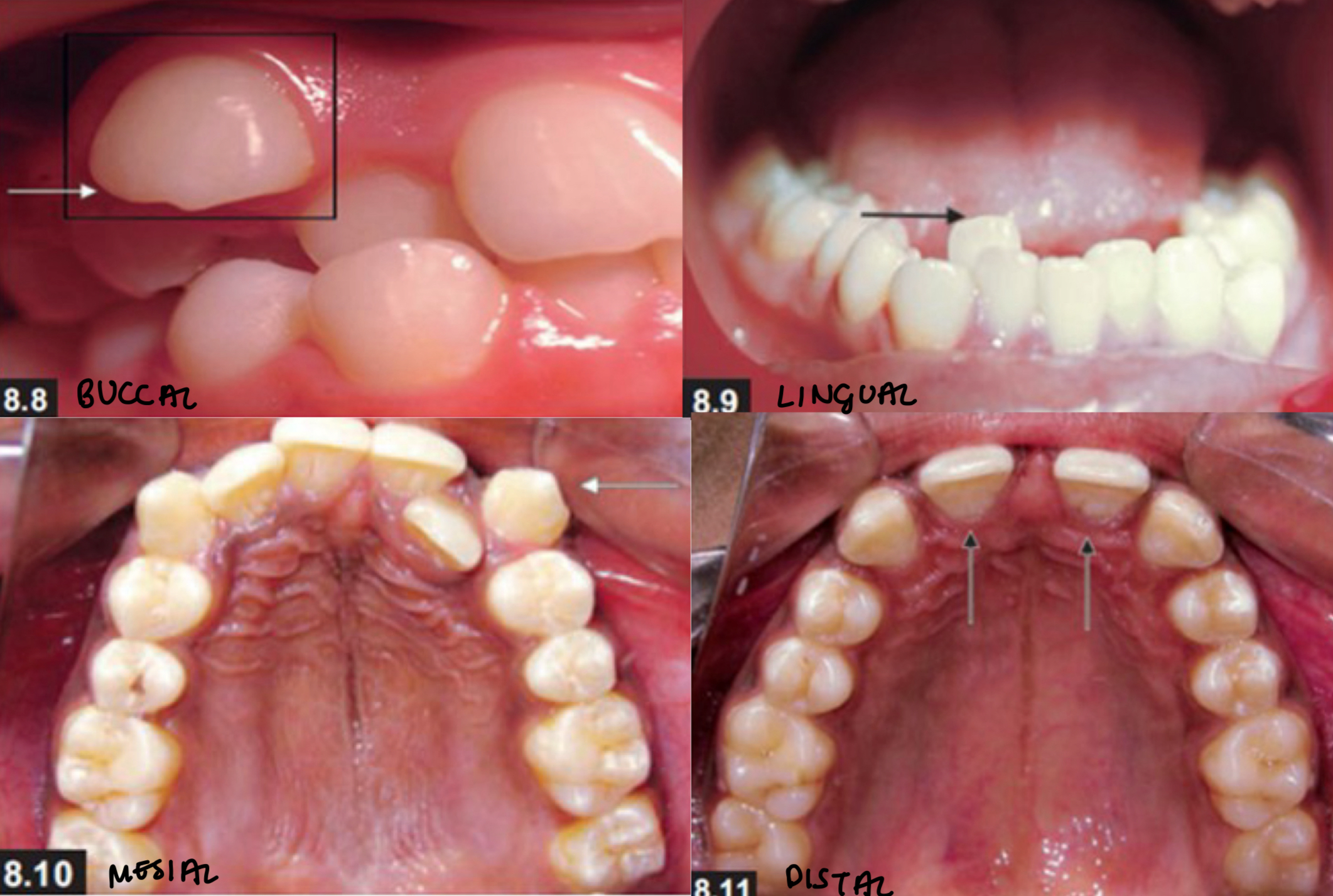 <p>Bodily movement of crown, apex position changes  </p><p>Buccal, lingual, mesial, distal </p>
