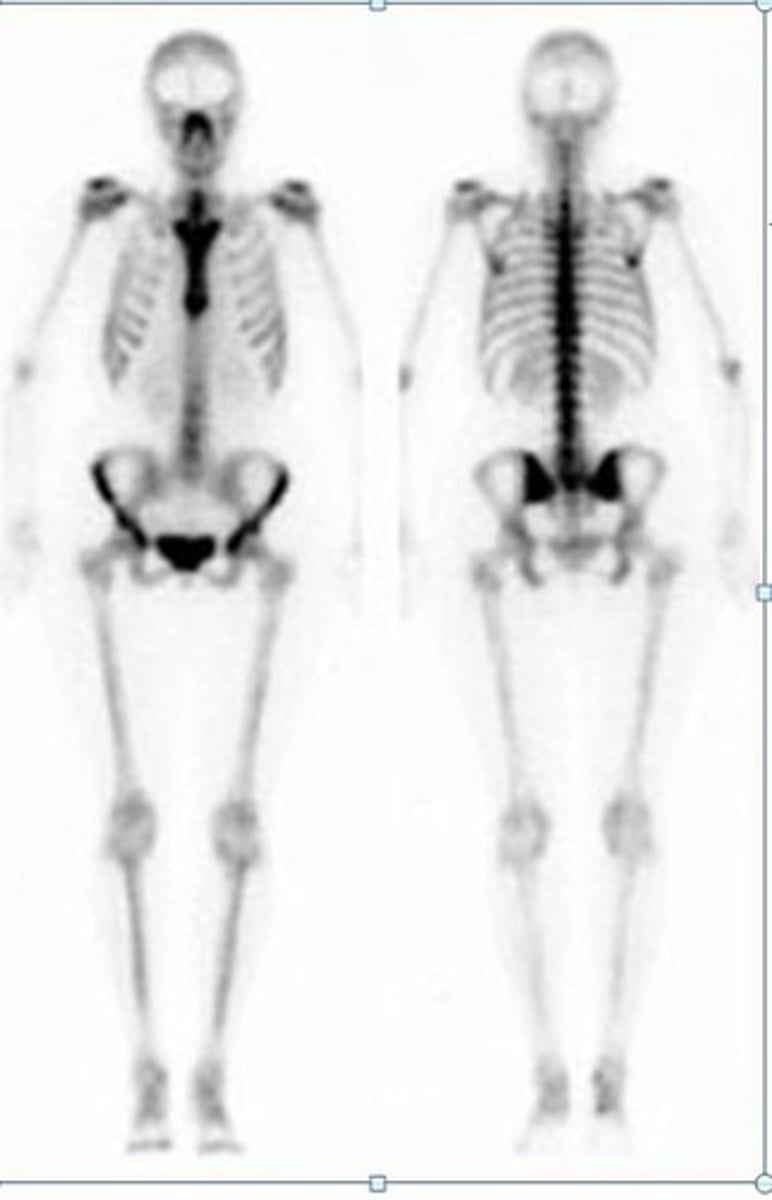<p>-Nuclear scanning test that identifies new areas of bone growth or breakdown</p><p>-Evaluates bone damage, metastasized cancer, monitor infection and trauma</p>