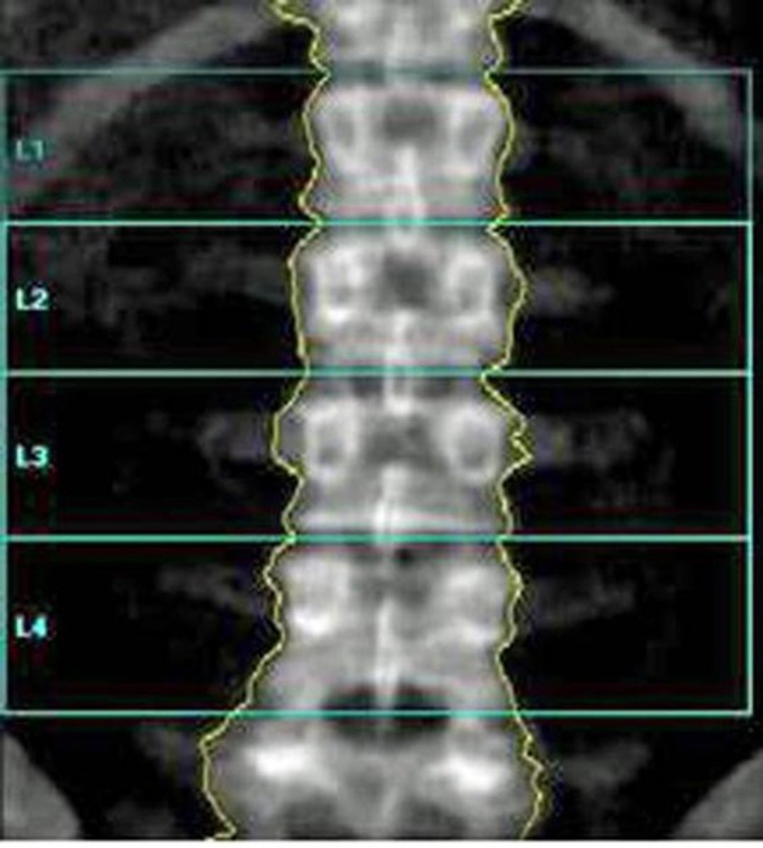 <p>hips and lumbar (L1-L4)</p><p>gold standard for osteoporosis</p>