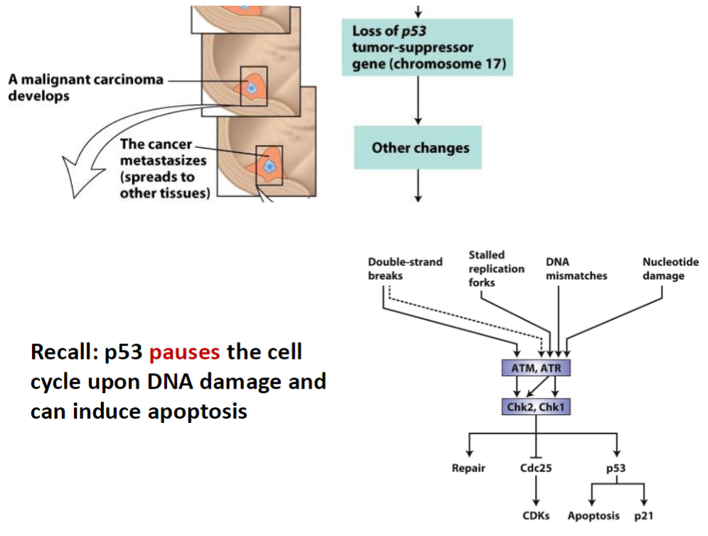 <p><strong>Malignant Transformation</strong><br> A <strong>malignant carcinoma</strong> develops from the benign adenoma</p><p><strong>Metastasis</strong><br> The cancer <strong>spreads to other tissues</strong>, establishing secondary tumors</p><p><strong>Genetic Changes</strong><br> <strong>Loss of p53</strong> (<strong>tumor-suppressor gene, chromosome 17</strong>)<br> Other genetic and epigenetic changes accumulate</p><p><strong>p53 Function</strong><br> <strong>p53</strong> pauses the <strong>cell cycle</strong> in response to <strong>DNA damage</strong><br> Can induce <strong>apoptosis</strong> to prevent propagation of damaged cells</p><p><strong>Key Concept</strong><br> Loss of <strong>p53</strong> removes a critical <strong>growth checkpoint</strong>, allowing <strong>malignant progression</strong> and <strong>metastasis</strong></p>