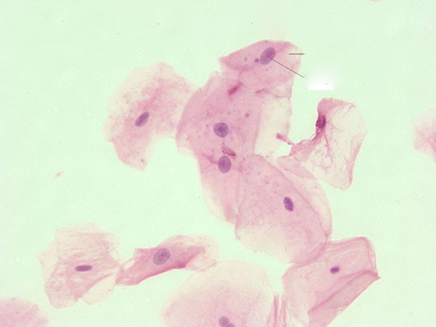 <p>They are the largest cells that appear in the sediment and contain abundant, irregular cytoplasm and a prominent nucleus about the size of an RBC. They could also be folded, resembling a cast, BUT a cast would NOT have a nucleus present</p><p>- They originate from the linings of the vagina and female urethra and the lower portion of the male urethra</p><p>Clinical Significance: They are normal cells that are seen in the urine and have NO significance.</p>