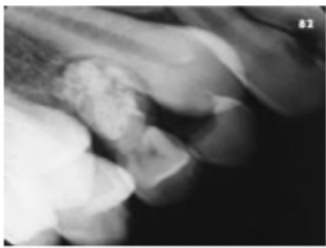 <p>Compound odontoma</p>