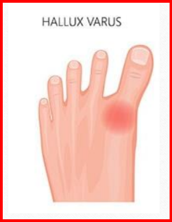 <p>Câu 13: Hallux<span style="color: red;"> varus </span>là gì?<span>&nbsp;</span></p><p class="MsoNormal">A. <span style="color: purple;">Ngón chân cái </span>đưa <span style="color: green;">ra ngoài</span> <span style="color: red;">(vẹo ngón cái ra ngoài</span>)<span style="font-family: "Segoe UI Symbol", sans-serif;"><span>✓</span></span><span>&nbsp;</span></p><p class="MsoNormal">B. Ngón chân cái đưa vào trong<span>&nbsp;</span></p><p class="MsoNormal">C. Ngón chân cái duỗi quá mức<span>&nbsp;</span></p><p class="MsoNormal">D. Ngón chân cái gập quá mức<span>&nbsp;</span></p>