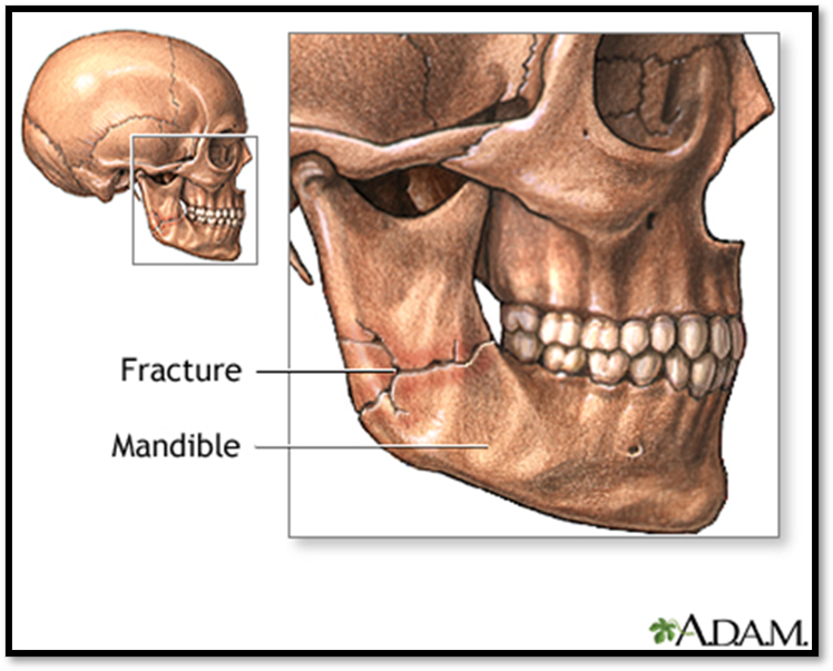 <p><strong><span>Mandibular Fracture </span>( Def. / S&amp;S / Comp. / Diagnostic / Tx / Nursing) </strong></p>