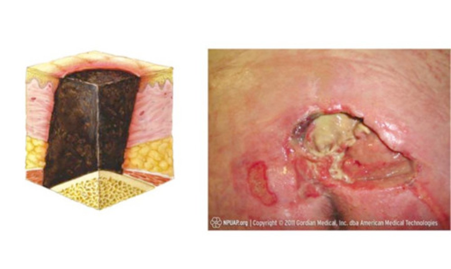 <p>- skin loss is full thickness and the base is completely covered with slough, or eschar, obscurring the true depth of the wound</p>