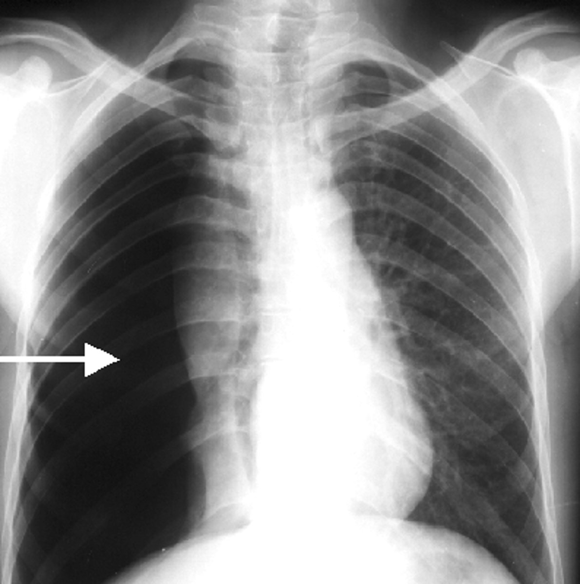 <p>air in the pleural cavity</p>