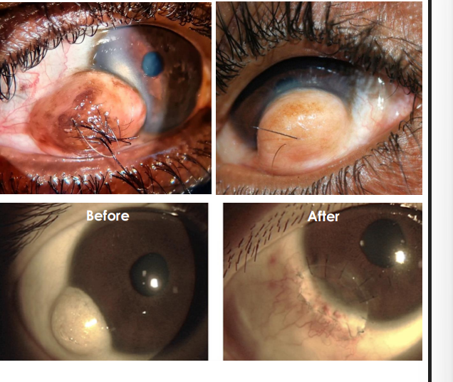 <ol><li><p>Variable size, <strong><u>yellow -white</u></strong> limbal mass often found <u>Nasal quadrant</u></p></li><li><p>• May contain <strong><u>fine hairs .</u></strong></p></li><li><p>• May have <strong><u>extensive corneal involvement</u></strong> causing <strong><u>irritation, astigmatism</u></strong>, and incomplete eyelid closure.</p></li></ol><p></p>