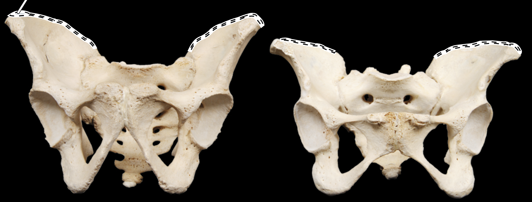 <p>Name the highlighted portion.</p><p>(Pelvis, anterior view).</p>