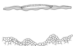 <p>Pérdida de una porción de la epidermis sin rebasar la membrana basal</p><p>Por infecciones superficiales bacterianas o traumas de superficie</p>