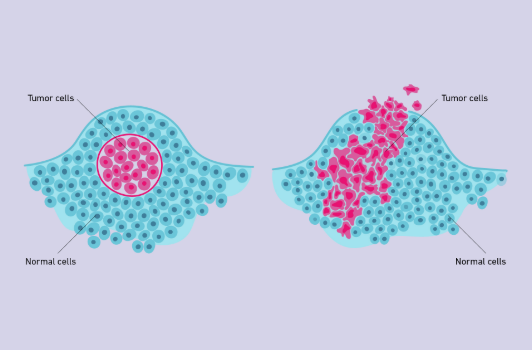 <p>A tumor that does not affect surrounding tissues other than by physically crowding them (Left)</p>