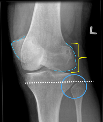 <p>good med 45 OBL</p><ul><li><p>MAIN: fib head free of SI / tib-fib joint open</p></li><li><p>SUPPORTING:</p><ul><li><p>½ patella free of SI</p></li><li><p><strong>lat.con in profile with no SI from med.con</strong></p></li></ul></li></ul><p></p>