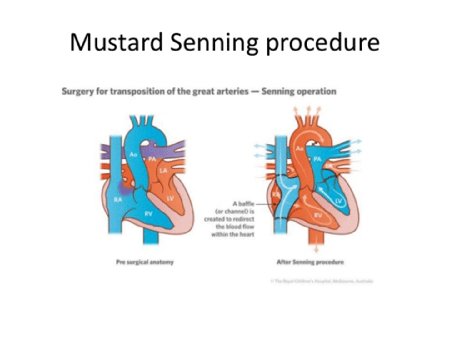 <p>Atrial Switch operation for D-transposition of the great vessels</p><p>creates a two-way baffle in the top part of the heart so blood going to left atrium is carried to the RV and the blood going to the right atrium is going to the LV. This baffle serves as a bridge between the two sides of the heart.</p>
