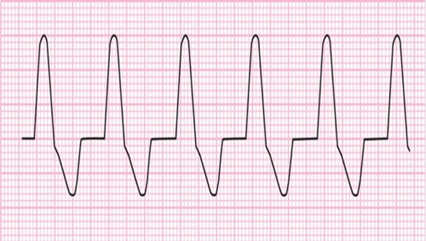 <p>Regular</p><p>Rate: 50-100</p><p>P wave: NONE</p><p>PR Interval: N/A</p><p>QRS: WIDE, &gt;0.12 sec</p>
