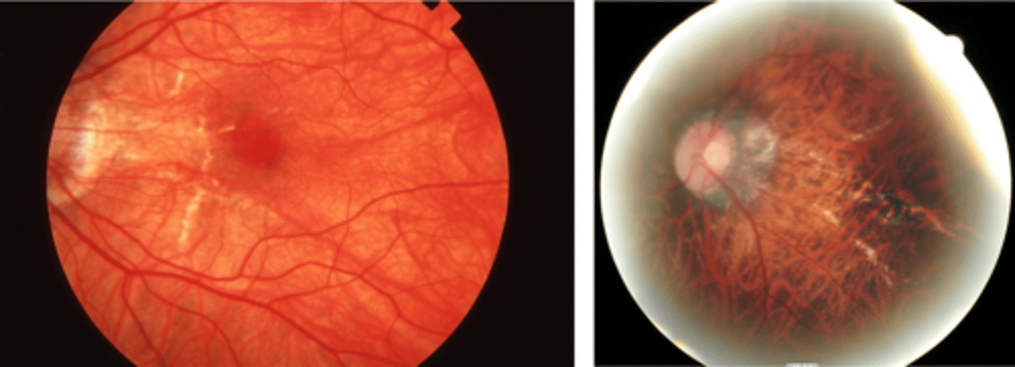 <p>breaks in Bruch's membrane that can expand and contract, mostly seen in degenerative myopia</p>