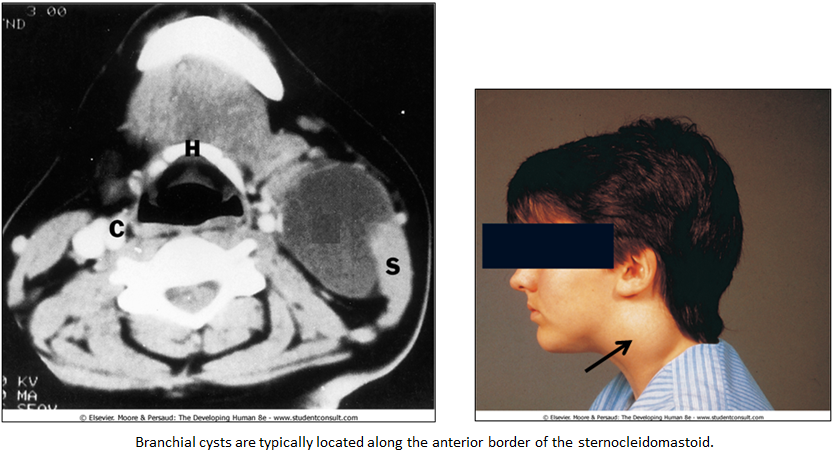 Branchial Cyst - Occurs when 2nd arch does not obliterate the rest of the pharygneal clefts