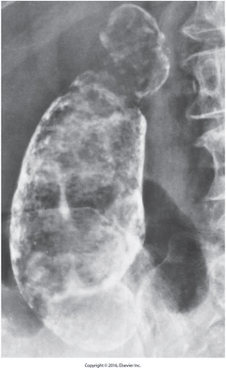 <p>What is porcelain gallbladder?</p>