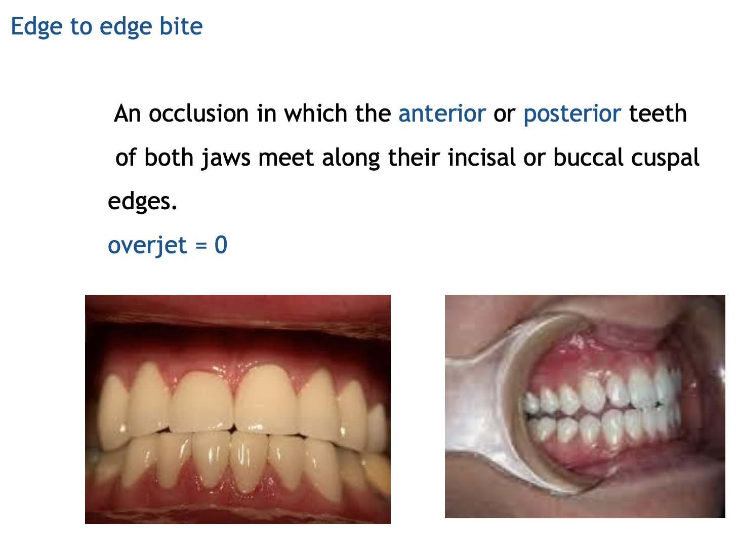 <p>Edge to edge is when the max incisal edges line up with the touching mand incisal edges with NO vertical overlap </p>