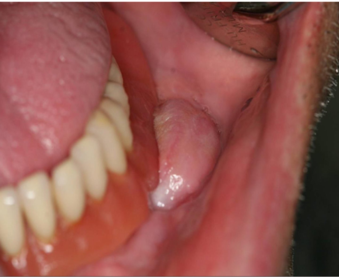 <p>Epulis fissuratum - treatment</p>